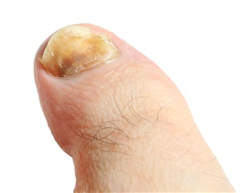 What Does Toenail Fungus Look Like - The most typical tests performed