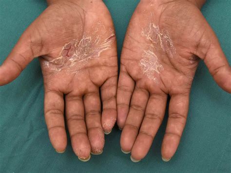 Cureus Dyshidrotic Eczema: A Common Cause Of Palmar, 48% OFF