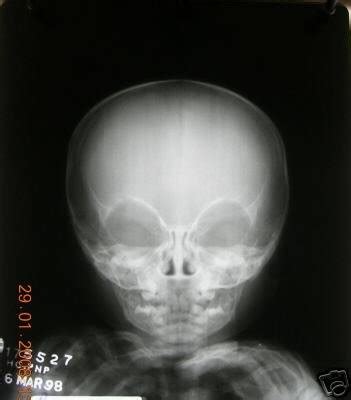 Human BABY SKULL x-ray real negative 10X12 | #36935152