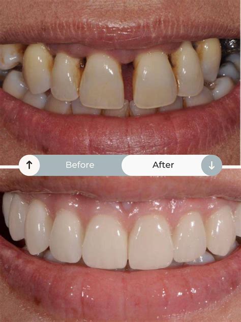 All on 6 | Costs, Process & More | The Perfect Smile Studios