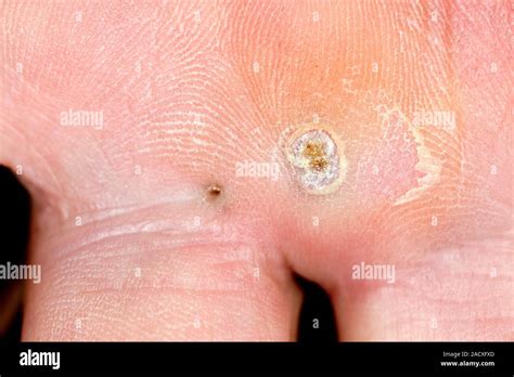 Infection at the site of a splinter on the palm of an 80-year-old man ...