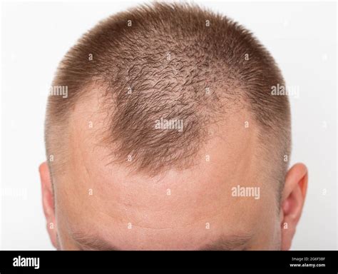 frontal bald patches  res stock photography  images alamy
