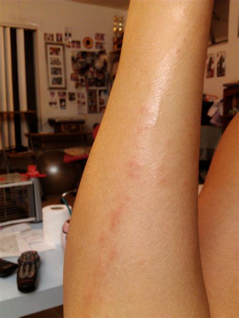 My Staph Story: My Staph Story