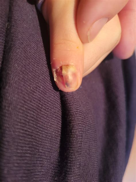 Youngest Daughter slammed finger in car door. : r/MedicalGore