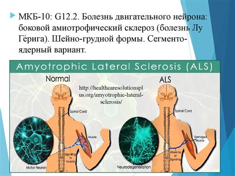 Клинический случай бокового амиотрофического склероза шейно-грудной ...