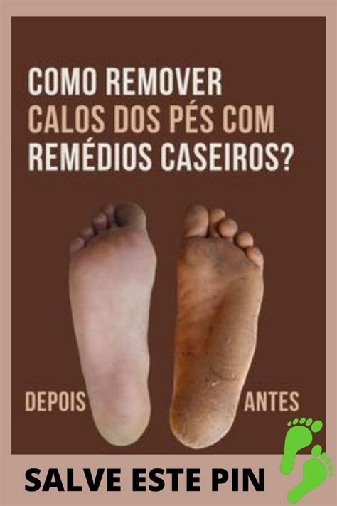 Calos Nos Pés Como Tirar - Calos Nos Pés: Saiba Como Tirar E Eliminar Definitivamente – DZXGZ