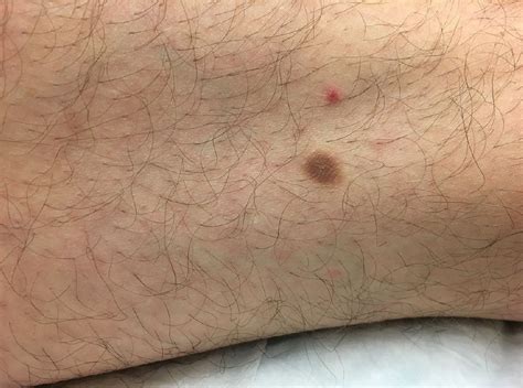 sebaceous cyst   thigh