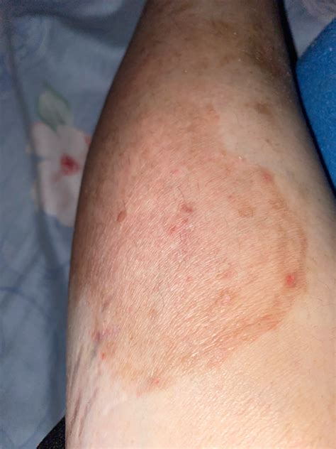 soal penyakit gatal hellosehat