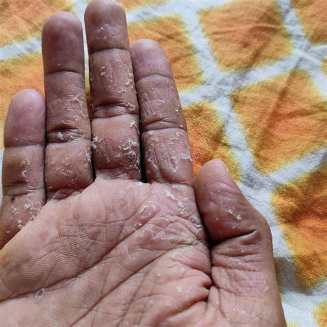 Acral peeling skin syndrome : r/IndianSkincareAddicts