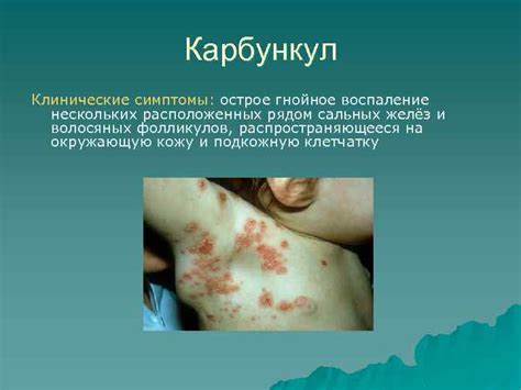 Пиодермии Классификация пиодермий по этиологии Пиодермии Стафилодермии