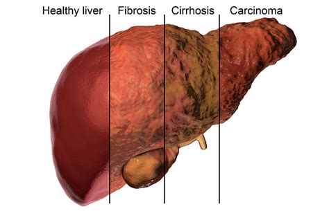 Liver Cirrhosis Stages