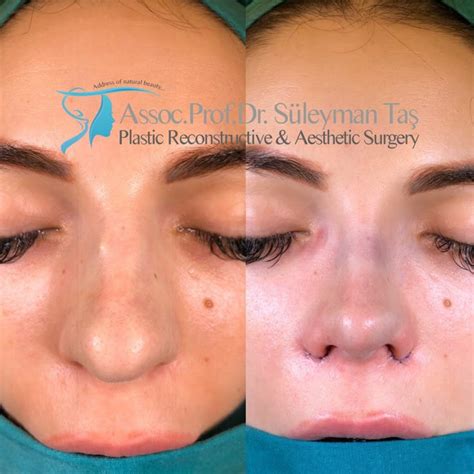 thick skin bulbous tip rhinoplasty prof dr suleyman tas