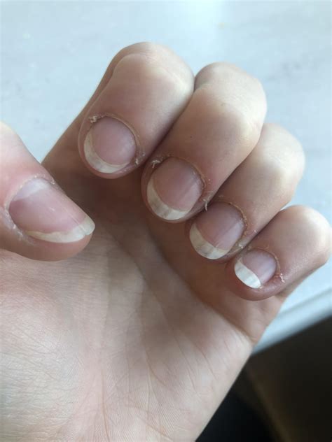 Hangnail Infected Hangnail: Causes, Treatment, And More