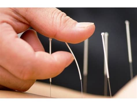 needling technique