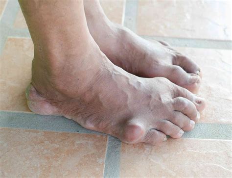 Got gout? Here's what to eat and avoid