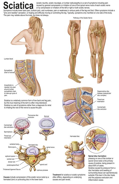 Meaning of lumbar spondylosis. Lumbar Spondylosis: Causes, Symptoms