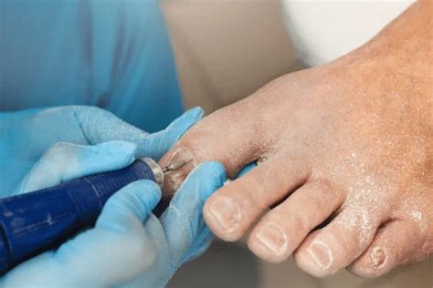 foot infection treatment  plano mckinney