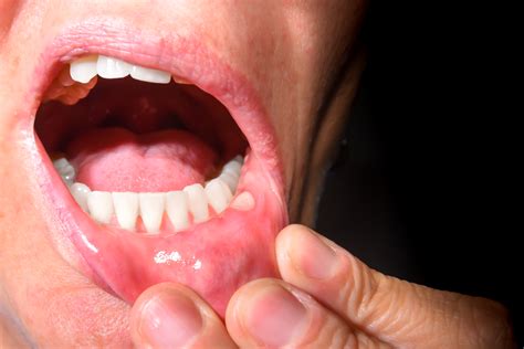 aphthae   mouth symptoms treatment usz
