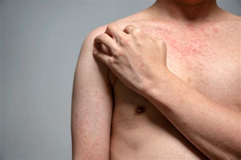 Measles Texas Reports 13 New Measles Cases As CDC Arrives In State