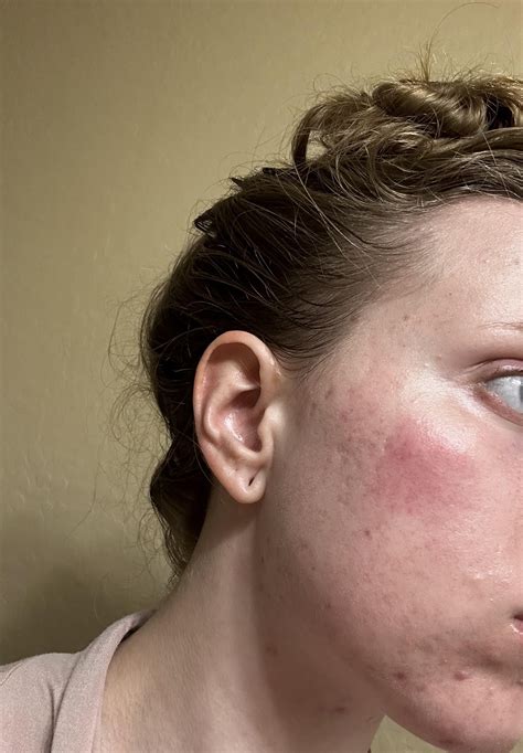 [product question]Dry red patch on face! Stings and burns when washing