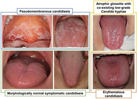 Chronic Hyperplastic Candidiasis