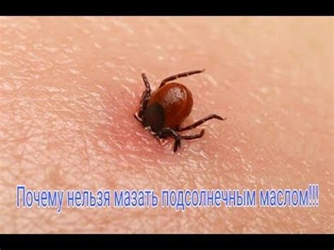 Как вытащить клеща! Как быстро вытащить клеща из тела человека|How to ...