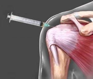 Cortisone Injections: The Good and Bad: Sports Medicine Center: Sports ...