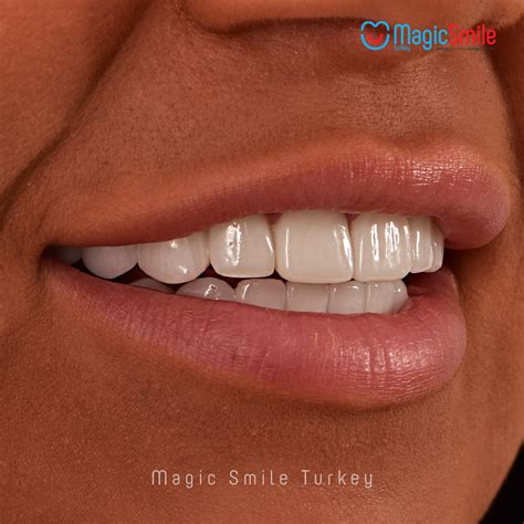 Dental Veneers Turkey - Magic Smile Turkey