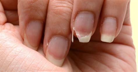 Unhas Fracas E Quebradiça - Unhas fracas, onduladas, quebradiças, por que ficam assim?