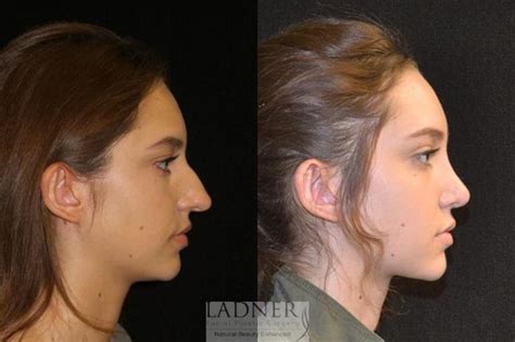 nostril surgery    rhinoplasty  nose job deconti