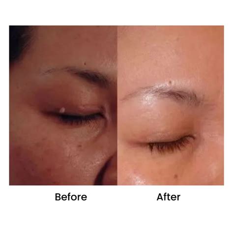 how to remove anal skin tag at home
