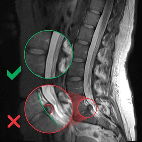 BLOG: Hernija diska – pogost vzrok težav v hrbtenici - Re.aktiv
