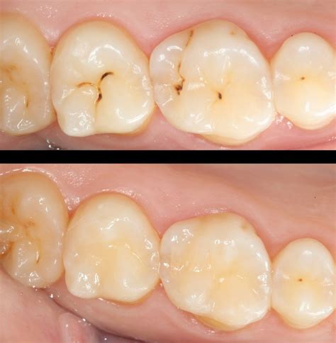 Caries prevention, diagnosis and treatment - Clínica Dental Padrós