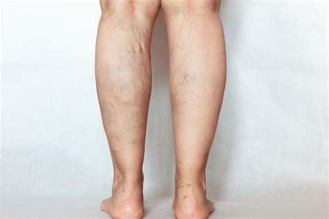 Recognizing the Early Warning Signs of DVT - FactAvenue