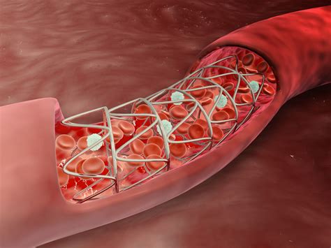 O Que É Stent No Coração - Stent: O Que É, Para Que Serve E Principais Tipos – JRRJS