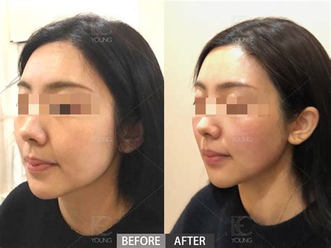 thermage flx ec aesthetic clinic london