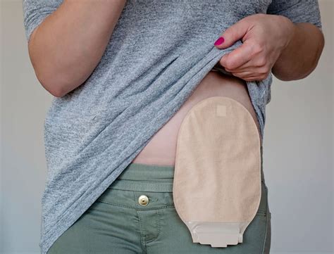 Colostomy: What is it and How is the Procedure Done?