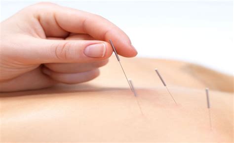 Acupuncture - Traditional Chinese Medicine