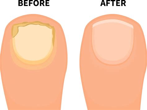 How to Get Rid of Nail Fungus Naturally: Effective Homeopathic Remedies