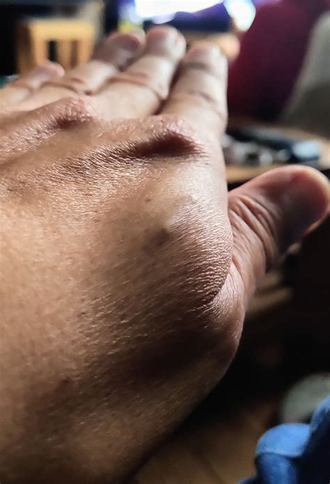 Have you ever tried to keep a implant secret and someone's found out