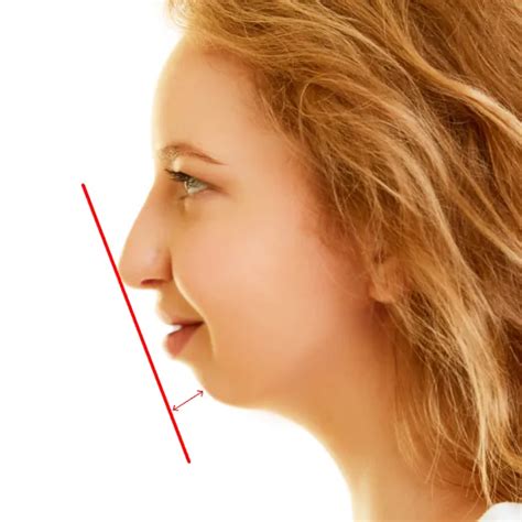 how to know if you have recessed jaw