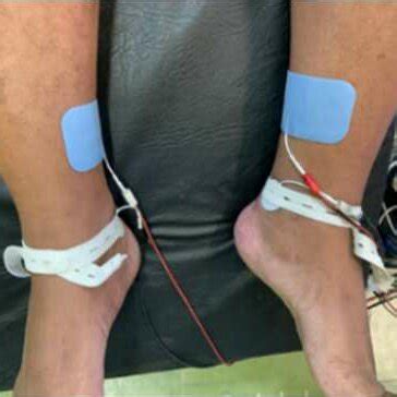 Non-Invasive Tibial nerve stimulation (TNS) | Download Scientific Diagram