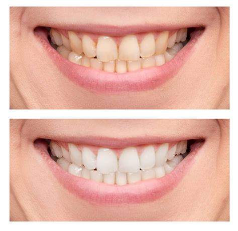Teeth Whitening in Turkey as an Alternative to Dental Veneers.