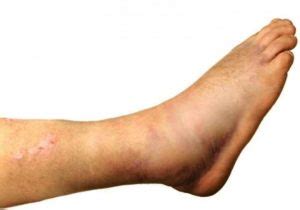 Health and Medical ArticlesWeeping Edema - Health and Medical Articles