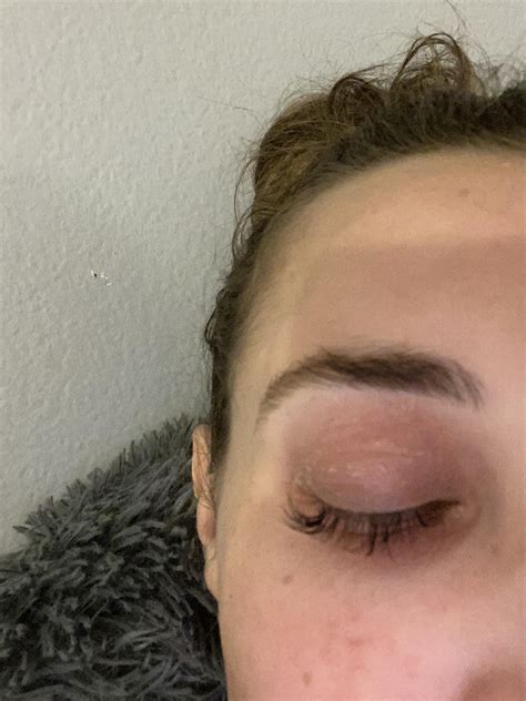 Dry Eyelid Breakout? : r/Skincare_Addiction