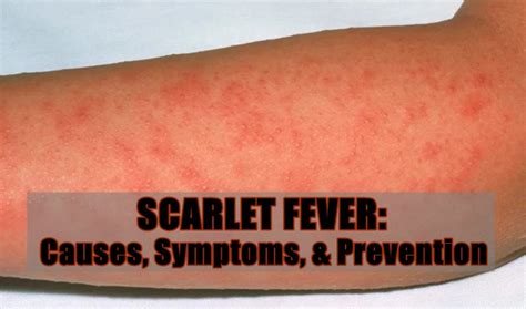 SCARLET FEVER: Causes, Symptoms & Prevention