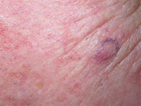 ACD A-Z of Skin - Merkel cell carcinoma
