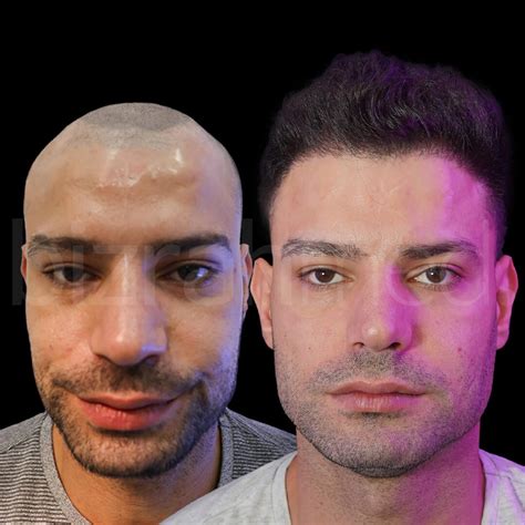 comparing hair transplant costs  countries bizrahmed