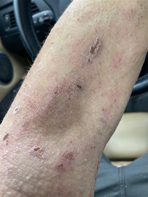 Staph infection : r/eczema