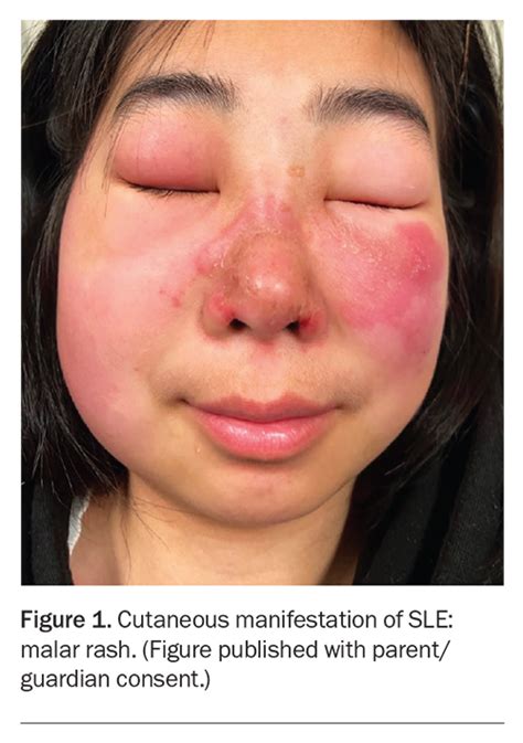 childhood onset systemic lupus erythematosus  clinical update